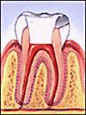 Dentindent - Kanal tedavisi