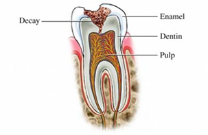 Dentindent - Diş çürükleri
