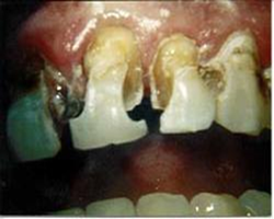 Dentindent - Diş çürükleri - Atipik Çürükler