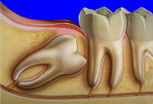 Dentindent - Gömülü Dişler