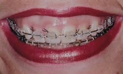 Dentindent - Ortodontik Tedavi